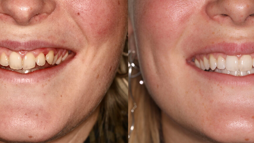 invisalign_før-og-efter-colosseum-tandlægerne