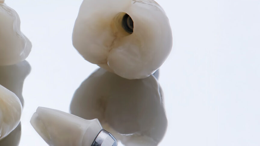 implantat_hvordan_fungerer_implantater